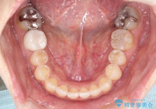 前歯のガタつきをマウスピース矯正で改善!　驚きの効果を体験しようの治療後