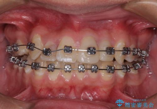 前歯のデコボコとむし歯だらけの歯列　矯正治療と虫歯治療の治療中