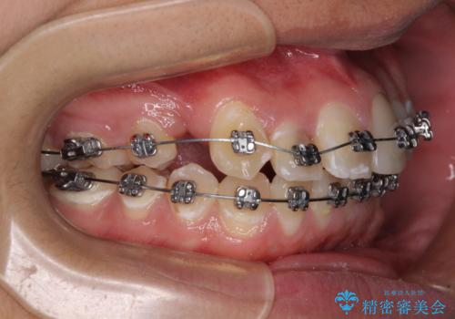 前歯のデコボコとむし歯だらけの歯列 矯正治療と虫歯治療の治療中