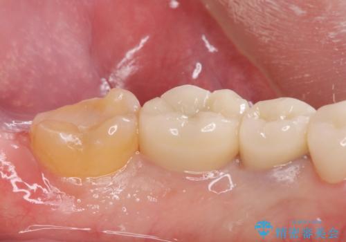 ゴールドクラウンの治療前