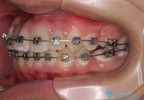 前歯のデコボコとむし歯だらけの歯列 矯正治療と虫歯治療の治療中