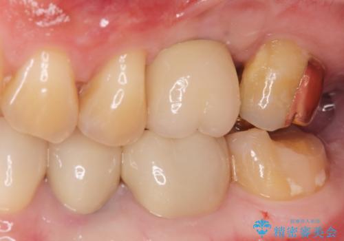 ゴールドクラウンの治療前