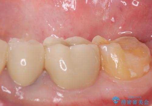 ゴールドクラウンの治療前