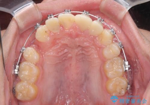 前歯のデコボコとむし歯だらけの歯列　矯正治療と虫歯治療の治療中