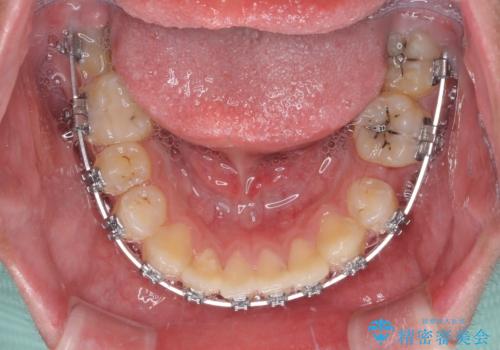 前歯のデコボコとむし歯だらけの歯列 矯正治療と虫歯治療の治療中