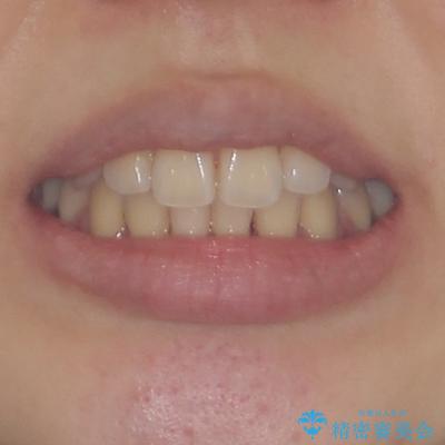 目立たないハーフリンガル矯正 抜歯矯正で口元の突出感を改善の治療後(顔貌)