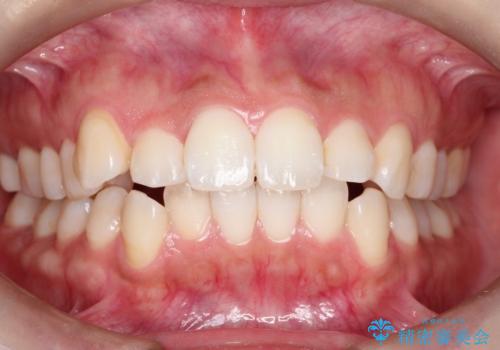 すっきり感アップ! ワイヤー矯正で口元を下げて魅力的な印象に!の症例 治療前