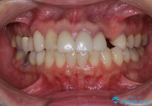 欠損やむし歯の歯をきれいなセラミックに 全顎虫歯治療の治療前