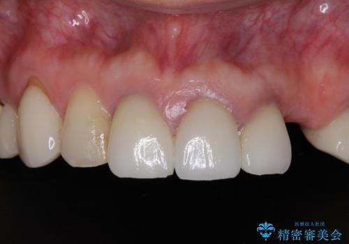 欠損やむし歯の歯をきれいなセラミックに　全顎虫歯治療の症例 治療前