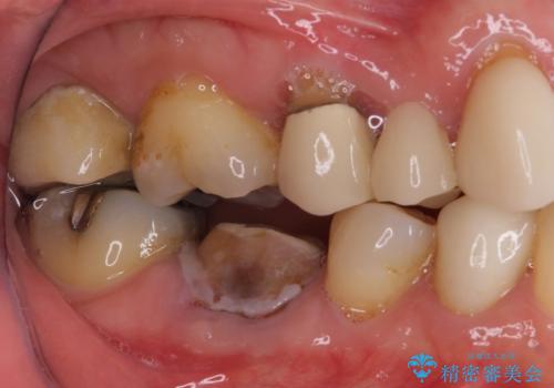 欠損やむし歯の歯をきれいなセラミックに 全顎虫歯治療の治療前