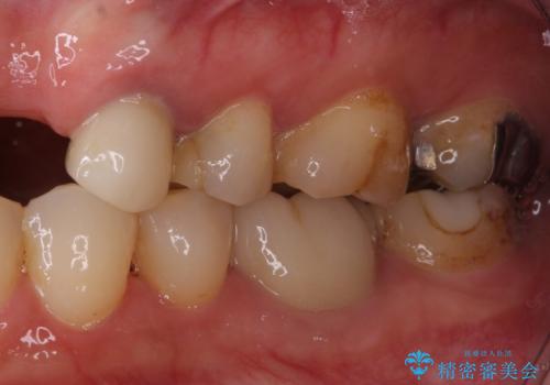 欠損やむし歯の歯をきれいなセラミックに 全顎虫歯治療の治療前