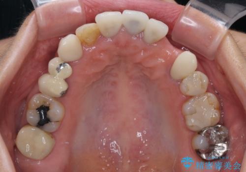 欠損やむし歯の歯をきれいなセラミックに 全顎虫歯治療の治療前
