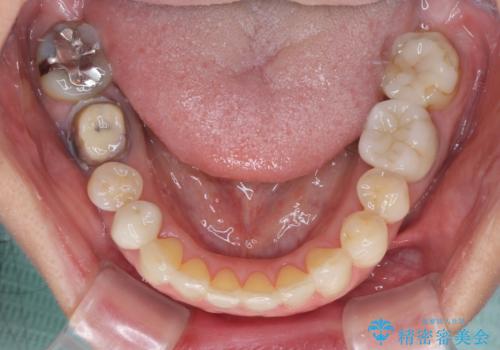 欠損やむし歯の歯をきれいなセラミックに 全顎虫歯治療の治療前