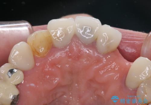 欠損やむし歯の歯をきれいなセラミックに 全顎虫歯治療の治療前