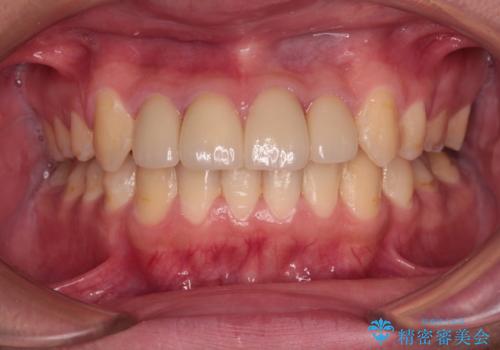 前歯のデコボコとむし歯だらけの歯列　矯正治療と虫歯治療の治療後