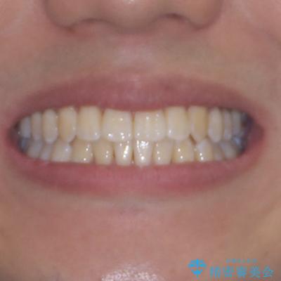 補助装置を併用してスムーズに インビザラインによる矯正治療の治療後(顔貌)