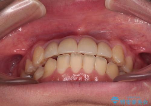 前歯のデコボコとむし歯だらけの歯列 矯正治療と虫歯治療の治療後