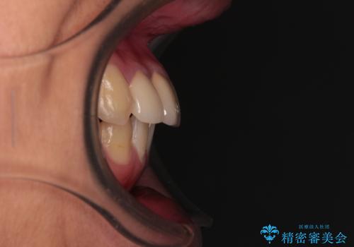 前歯のデコボコとむし歯だらけの歯列 矯正治療と虫歯治療の治療後