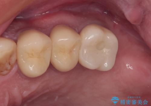 根管治療を行ったままの奥歯　オールセラミッククラウンによる補綴治療の治療後