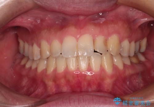 【モニター】上下前歯の叢生を解消 インビザライン矯正治療