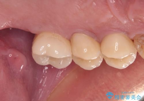根管治療を行ったままの奥歯 オールセラミッククラウンによる補綴治療の治療後