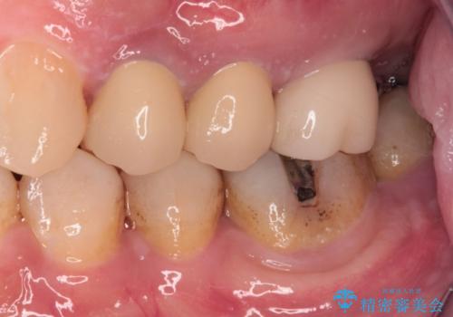 根管治療を行ったままの奥歯 オールセラミッククラウンによる補綴治療の治療後