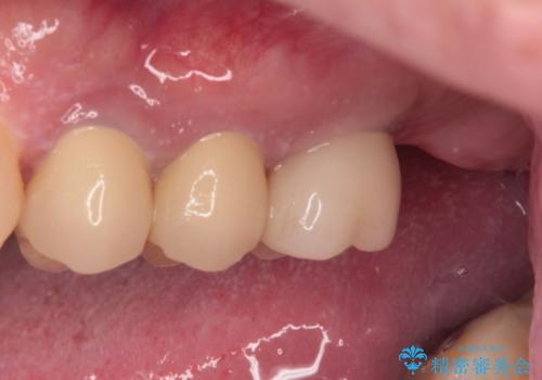 根管治療を行ったままの奥歯 オールセラミッククラウンによる補綴治療の治療後