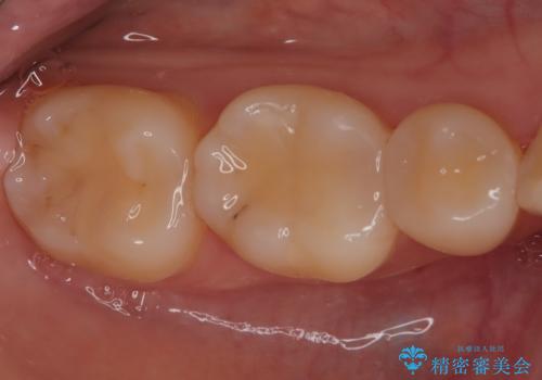 【ハイブリッドインレー】銀歯を白くしたい の治療後