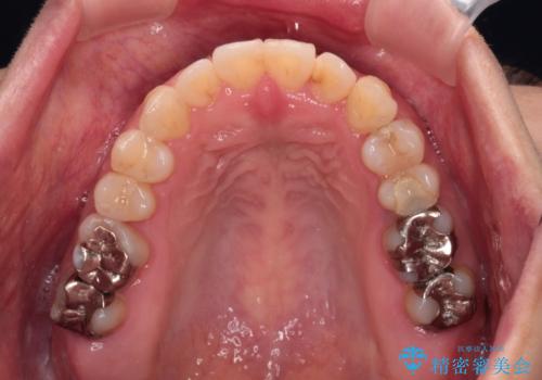 【モニター】上下前歯の叢生を解消　インビザライン矯正治療の治療後