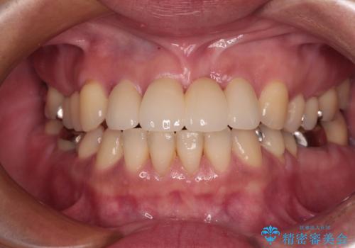 中途半端な矯正治療と前歯の欠損　再矯正とオールセラミッククラウンによる補綴治療の症例 治療後