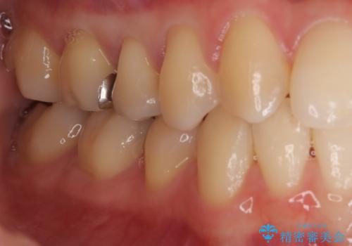 【ハイブリッドインレー】銀歯を白くしたい の治療後