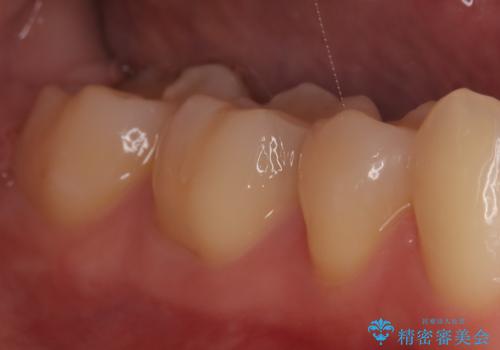 【ハイブリッドインレー】銀歯を白くしたい の治療後