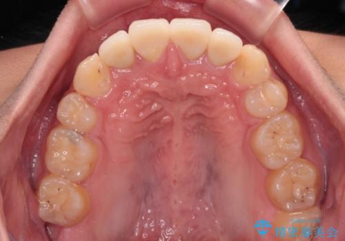 前歯のデコボコとむし歯だらけの歯列　矯正治療と虫歯治療の治療後