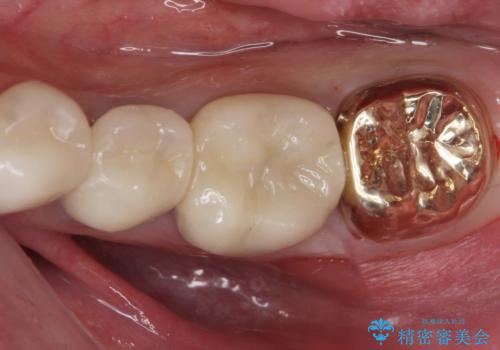 ゴールドクラウンの症例 治療後