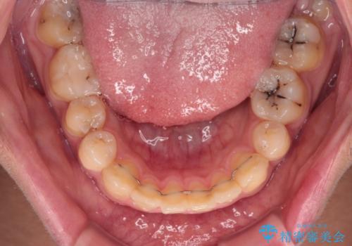 前歯のデコボコとむし歯だらけの歯列 矯正治療と虫歯治療の治療後