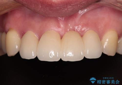 中途半端な矯正治療と前歯の欠損 再矯正とオールセラミッククラウンによる補綴治療の治療後