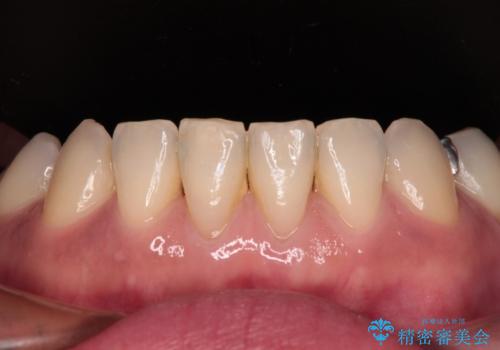 中途半端な矯正治療と前歯の欠損 再矯正とオールセラミッククラウンによる補綴治療の治療後