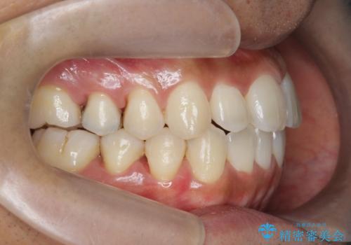 マウスピース矯正で前歯の見た目を治したいの治療後