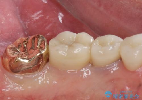 ゴールドクラウンの治療後