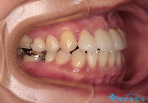 中途半端な矯正治療と前歯の欠損 再矯正とオールセラミッククラウンによる補綴治療の治療後