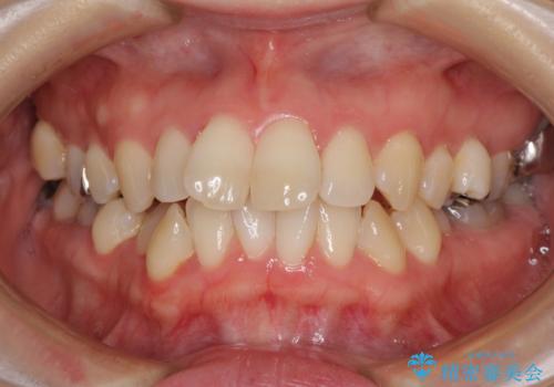 大きなむし歯の奥歯を抜歯してスペースを活用　ワイヤー装置による抜歯矯正の症例 治療前