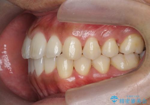 マウスピース矯正で前歯の見た目を治したいの治療後