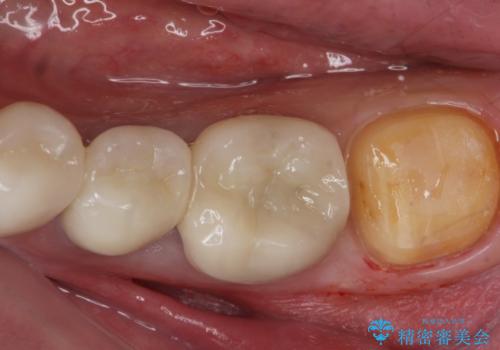 ゴールドクラウンの治療中