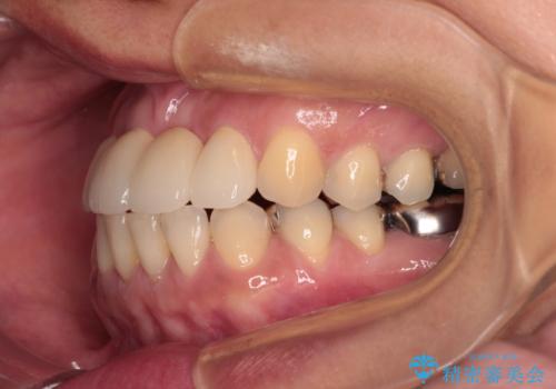 中途半端な矯正治療と前歯の欠損　再矯正とオールセラミッククラウンによる補綴治療の治療後