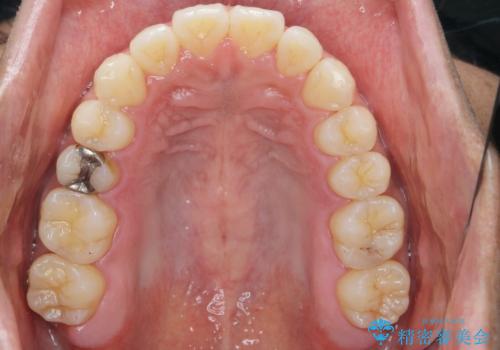 マウスピース矯正で前歯の見た目を治したいの治療後