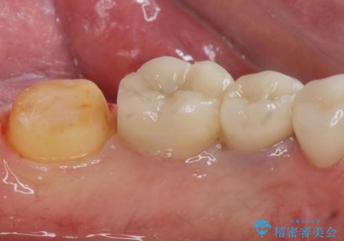 ゴールドクラウンの治療中