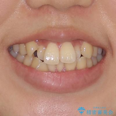 目立たないハーフリンガル矯正　抜歯矯正で口元の突出感を改善の治療前（顔貌）