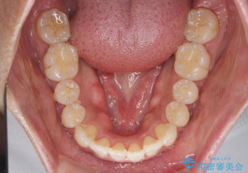 マウスピース矯正で前歯の見た目を治したいの治療後