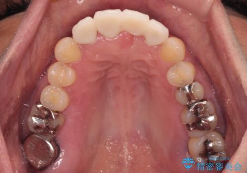中途半端な矯正治療と前歯の欠損 再矯正とオールセラミッククラウンによる補綴治療の治療後