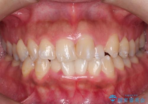 前歯のガタつきをマウスピース矯正で改善!　驚きの効果を体験しようの症例 治療前